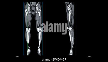 Ein CT-Venogramm des Beines ist ein nicht-invasives Bildgebungsverfahren, das detaillierte Visualisierungen der Beinvenen ermöglicht. Stockfoto