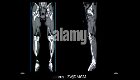 Ein CT-Venogramm des Beines ist ein nicht-invasives Bildgebungsverfahren, das detaillierte Visualisierungen der Beinvenen ermöglicht. Stockfoto