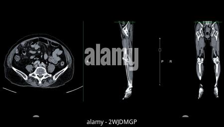 Ein CT-Venogramm des Beines ist ein nicht-invasives Bildgebungsverfahren, das detaillierte Visualisierungen der Beinvenen ermöglicht. Stockfoto