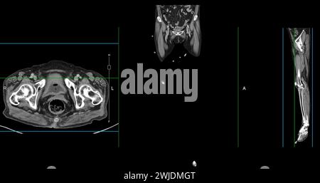 Ein CT-Venogramm des Beines ist ein nicht-invasives Bildgebungsverfahren, das detaillierte Visualisierungen der Beinvenen ermöglicht. Stockfoto