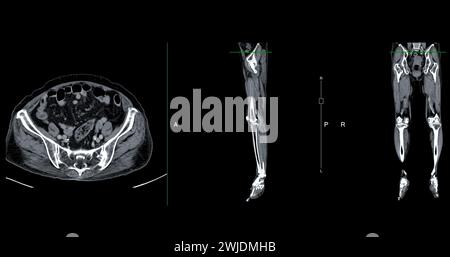Ein CT-Venogramm des Beines ist ein nicht-invasives Bildgebungsverfahren, das detaillierte Visualisierungen der Beinvenen ermöglicht. Stockfoto