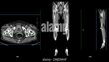 Ein CT-Venogramm des Beines ist ein nicht-invasives Bildgebungsverfahren, das detaillierte Visualisierungen der Beinvenen ermöglicht. Stockfoto