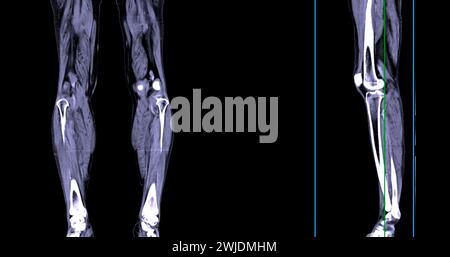 Ein CT-Venogramm des Beines ist ein nicht-invasives Bildgebungsverfahren, das detaillierte Visualisierungen der Beinvenen ermöglicht. Stockfoto