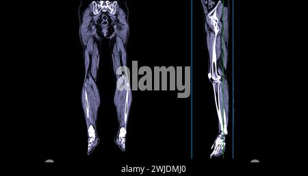 Ein CT-Venogramm des Beines ist ein nicht-invasives Bildgebungsverfahren, das detaillierte Visualisierungen der Beinvenen ermöglicht. Stockfoto