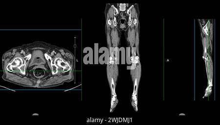 Ein CT-Venogramm des Beines ist ein nicht-invasives Bildgebungsverfahren, das detaillierte Visualisierungen der Beinvenen ermöglicht. Stockfoto