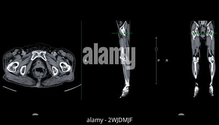 Ein CT-Venogramm des Beines ist ein nicht-invasives Bildgebungsverfahren, das detaillierte Visualisierungen der Beinvenen ermöglicht. Stockfoto