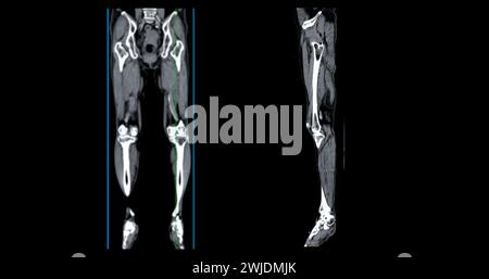 Ein CT-Venogramm des Beines ist ein nicht-invasives Bildgebungsverfahren, das detaillierte Visualisierungen der Beinvenen ermöglicht. Stockfoto