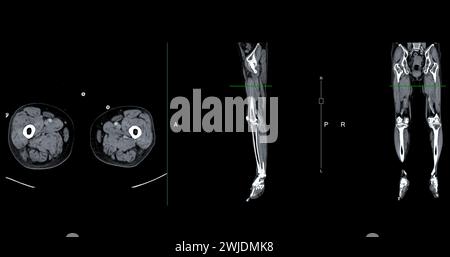 Ein CT-Venogramm des Beines ist ein nicht-invasives Bildgebungsverfahren, das detaillierte Visualisierungen der Beinvenen ermöglicht. Stockfoto
