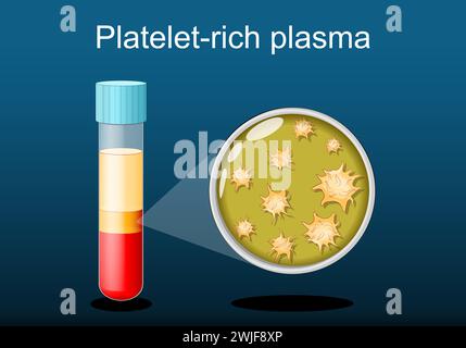 PRP. Reagenzglas mit Blut- und plättchenreichem Plasma. Bestandteile des Blutes. Regenerative Medizin für Gewebereparatur und Wundheilungsverfahren. Sportmedizin Stock Vektor