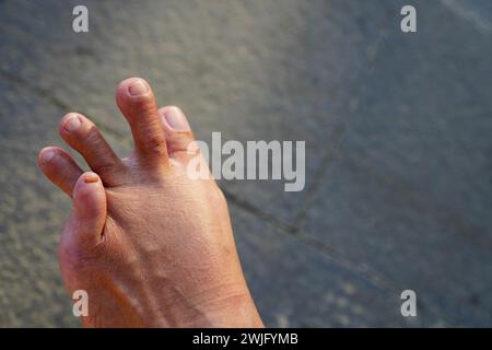 Die kleine Zehe des menschlichen Fußes ist einzigartig und kann über die Oberseite der Ringzehe gebogen werden Stockfoto