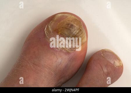 Ein großer Zeh einer Person mit einem beschädigten Nagelpilz. Nahaufnahme. Stockfoto