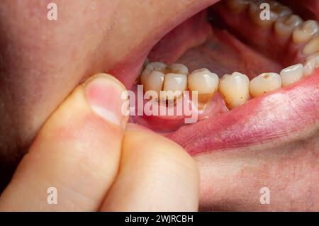 Eine detaillierte Ansicht einer Person, die ihre Zähne putzt, zeigt die Wirkung des Putzens und des Mundstücks der Person. Stockfoto