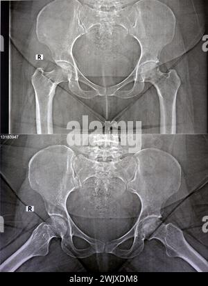 Eine einfache Röntgenaufnahme zeigt eine bilaterale avaskuläre Nekrose (AVN) des Femurkopfes mehr auf der linken Seite, eine Art aseptischer Osteonekrose, die durch eine Deaktivierung verursacht wird Stockfoto