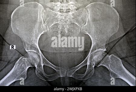 Eine einfache Röntgenaufnahme zeigt eine bilaterale avaskuläre Nekrose (AVN) des Femurkopfes mehr auf der linken Seite, eine Art aseptischer Osteonekrose, die durch eine Deaktivierung verursacht wird Stockfoto