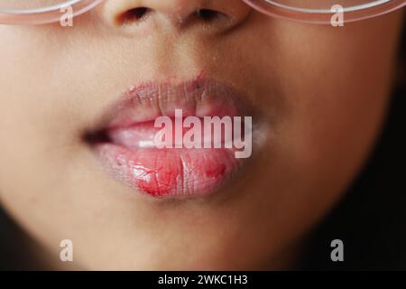 Nahaufnahme der trockenen Lippe eines Kindes Stockfoto
