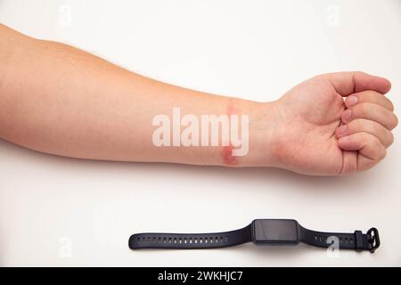 Rötungen und Allergien am Handgelenk einer Person durch das Tragen eines Fitnessarmbands mit Silikonband. Kontaktdermatitis Stockfoto