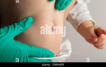 Ein Arzt in medizinischen Handschuhen untersucht den Bauch eines neugeborenen Babys mit einem vergrößerten Nabelring und einer Nabelhernie, Nahaufnahme. Stockfoto