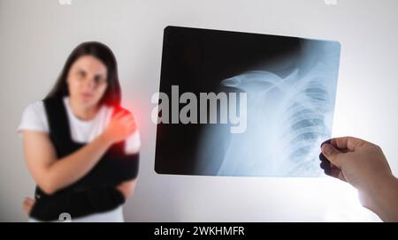 Der Arzt hält in der Hand ein medizinisches Röntgenbild eines ausgelenkten Humerus und eines gebrochenen Schlüsselbeins vor dem Hintergrund eines Mädchens, dessen Schulter Stockfoto