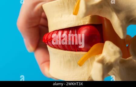Konvexer roter Bandscheibenvorfall am Wirbelsäulenmodell. Behandlung von Problemen und Erkrankungen der Wirbelsäule. Orthopädie und Vertebrologie. Stockfoto