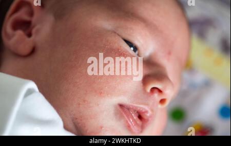 Allergische Pickel bei einem Neugeborenen im Gesicht. Pathogenese, Akne des Neugeborenen, Nahaufnahme Stockfoto