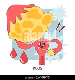 PCOS, polyzystisches Ovarialsyndrom. Das weibliche Fortpflanzungssystem. Endokrine Systemorganerkrankungen. Das Sekretionsungleichgewicht menschlicher Hormone. Illustration des flachen Vektors Stock Vektor