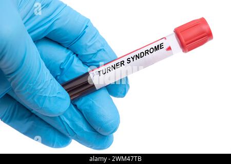 Turner-Syndrom-Bluttest Stockfoto