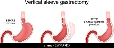 Vertikalhülse-Gastrektomie. Magen vor und nach einem chirurgischen Gewichtsabnahmeverfahren. Bariatrische Chirurgie. Adipositas-Behandlung. Querschnitt eines Menschen Stock Vektor