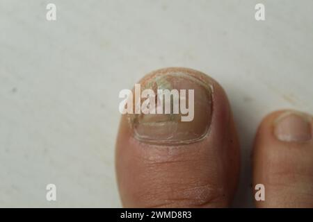 Pilzerkrankungen der Nägel und der Haut der Füsse Nahaufnahme. Podologie und Behandlungsmöglichkeiten für Nagelplatten. Nagelzerstörung. Stockfoto