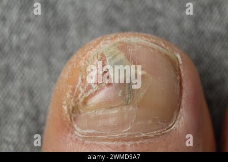 Nagelerkrankungen. Zerstörte Nagelplatte, Pilzerkrankungen der Füße. Podologie. Stockfoto