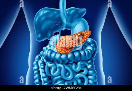 Bauchspeicheldrüsenkrebs Anatomie Konzept und Bauchspeicheldrüse bösartiger Tumor Symbol als verdauungsfördernde Drüse Körper Teil mit einem mikroskopischen Vergrößerung der bösartigen tum Stockfoto