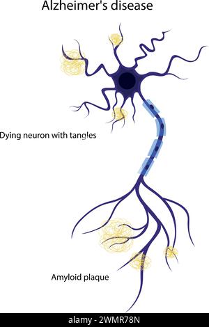 Geschädigtes Neuron. Die Struktur eines erkrankten Neurons. Alzheimer-Krankheit. Hirnerkrankungen Demenz, Gedächtnisstörungen. Stock Vektor