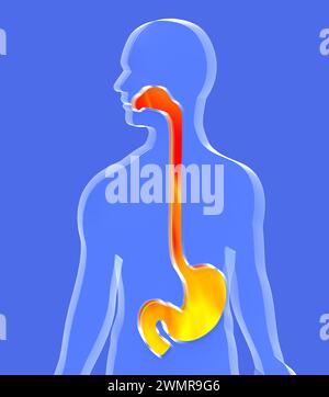 3. Darstellung von Magen und Speiseröhre bis zum Mund mit Verdauungsstörungen. Darstellung des Verdauungssystems im transparenten Glasrelief auf menschlicher Silhouette. Stockfoto