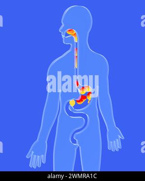 3D-Darstellung des Osophagus mit Magenreflux und Sodbrennen. Mit Feuerbällen. Verdauungssystem und menschliche Silhouette aus transparentem Glas. Stockfoto