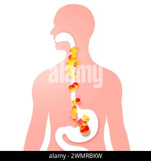 3D-Darstellung des Osophagus mit Magenreflux und Sodbrennen. Mit Pfeilen und Kreisen aus Feuer nach oben. Verdauungssystem und menschliche Silhouette. Stockfoto