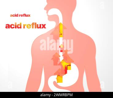 3D-Darstellung des Osophagus mit Magenreflux und Sodbrennen. Mit Pfeilen und Feuerkreisen nach oben und dem Wort „Säurerückfluss“. Stockfoto