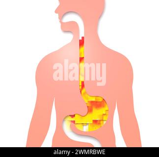 3D-Darstellung des Osophagus mit Magenreflux und Sodbrennen. Mit flachen Feuerquadraten, die sich nach oben bewegen. Verdauungssystem und menschliche Silhouette auf Wi Stockfoto