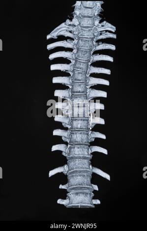 Spinale mrt-Bilder Stockfoto