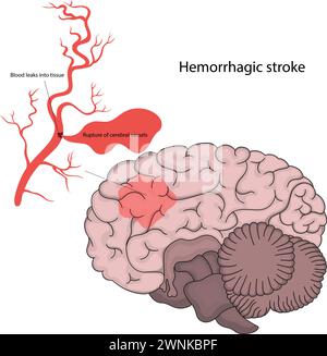 Vektorillustration des hämorrhagischen Schlaganfalls. Stock Vektor