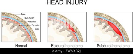 Epidurales Hämatom und subdurales Hämatom. Schädel-Hirn-Trauma. Querschnitt eines menschlichen Schädels. Nahaufnahme einer Hirnmeningen. Pia Mater, Dura Matter, Stock Vektor