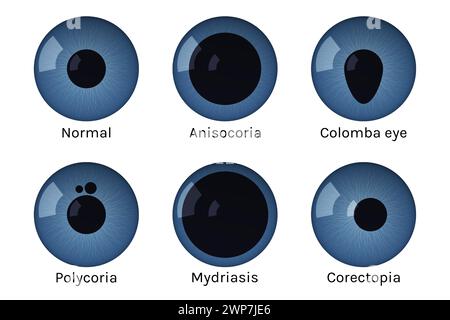 Augenpupillen mit Krankheitsvektorillustration. Normal, Anisokorie, colomba, Polykorie, Mydriasis-Korektopie Stock Vektor