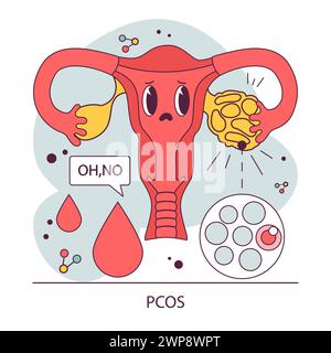 PCOS, polyzystisches Ovarialsyndrom. Das weibliche Fortpflanzungssystem. Endokrine Systemorganerkrankungen. Das Sekretionsungleichgewicht menschlicher Hormone. Illustration des flachen Vektors Stock Vektor