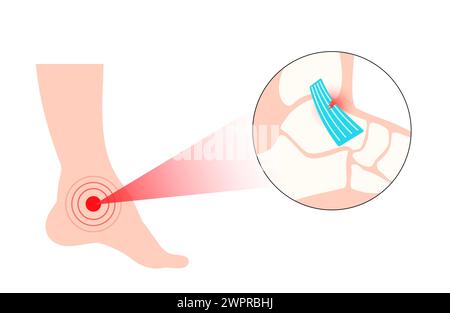 Sprunggelenksverstauchung, Illustration Stockfoto
