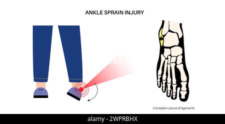 Sprunggelenksverstauchung, Illustration Stockfoto