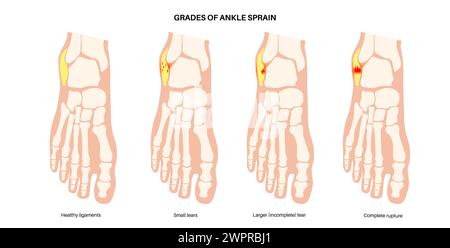Sprunggelenksverstauchung, Illustration Stockfoto
