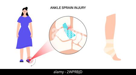 Sprunggelenksverstauchung, Illustration Stockfoto