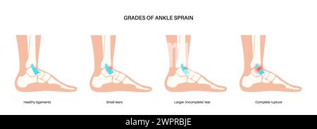 Sprunggelenksverstauchung, Illustration Stockfoto