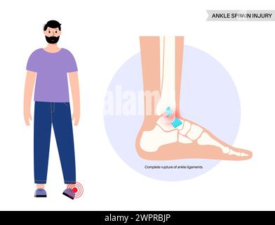 Sprunggelenksverstauchung, Illustration Stockfoto