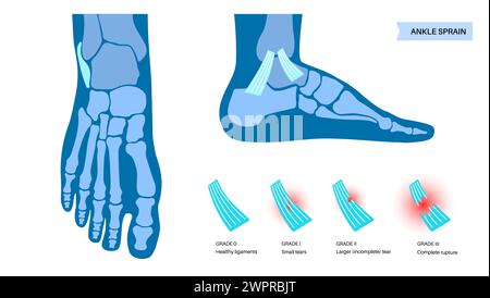 Sprunggelenksverstauchung, Illustration Stockfoto