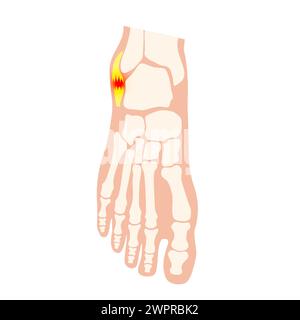 Sprunggelenksverstauchung, Illustration Stockfoto