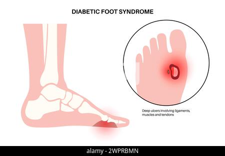 Diabetische Fussgeschwüre, Illustration Stockfoto